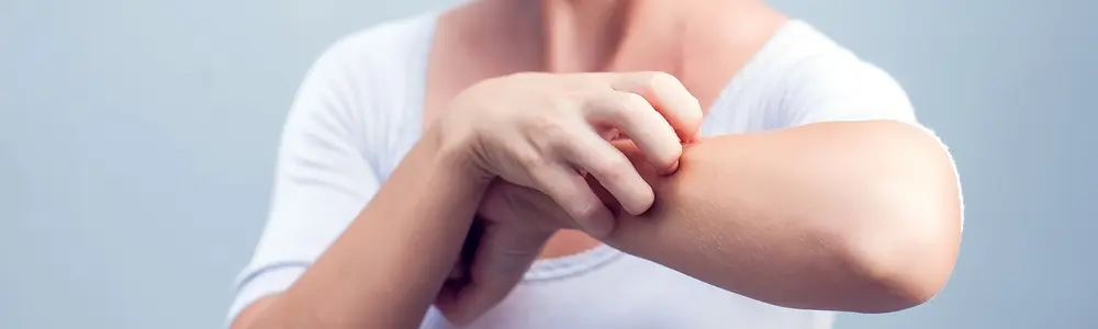 Adult Eczema: Naturopathic Approaches